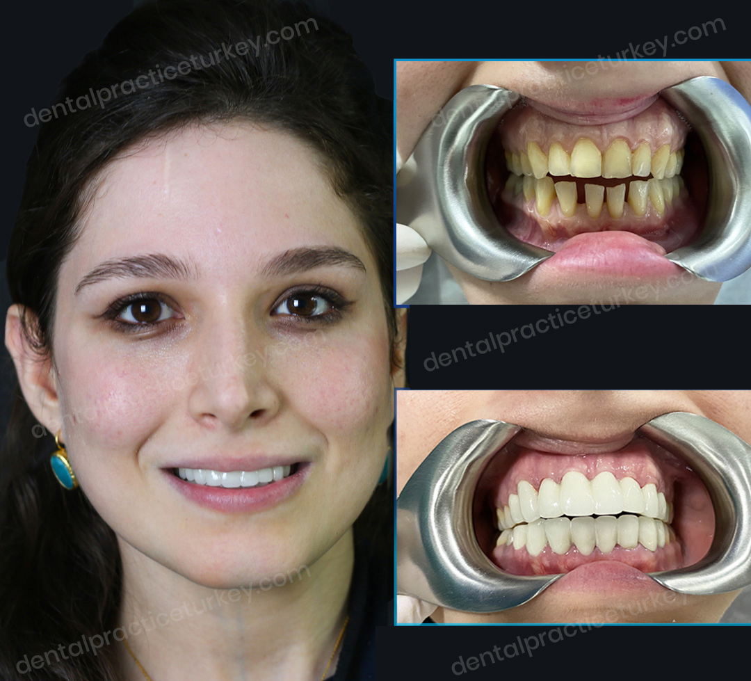 Dental-veneers before after